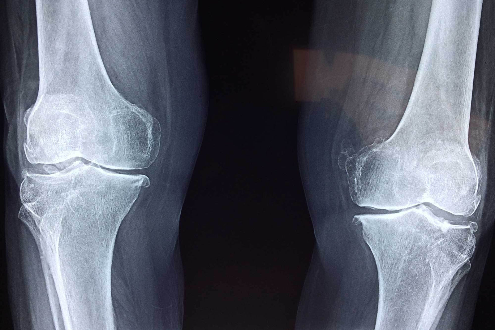 Can Knee Braces Help You Recover from a Torn Meniscus Injury?